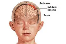 Beyin Kanaması Çeşitleri Nelerdir?