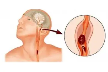 Beyin Sapı Tıkanması Belirtileri ve Tedavisi