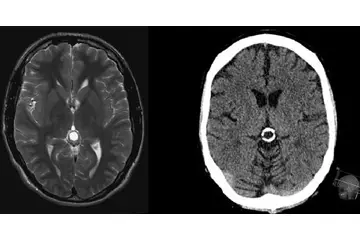 Doğuştan Beyinde Kist Belirtileri ve Tedavisi
